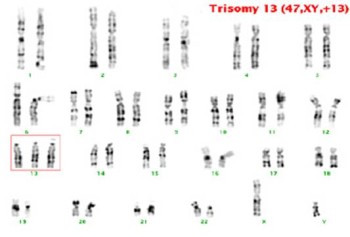 Patau Syndrome Patau (9).jpg